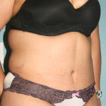 Tummy Tuck