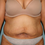 Tummy Tuck