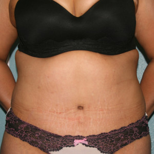 Tummy Tuck