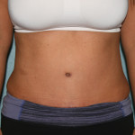 Tummy Tuck