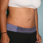 Tummy Tuck