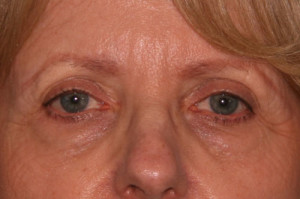 Eyelid Surgery