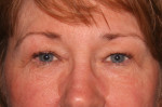 Eyelid Surgery