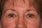 Eyelid Surgery