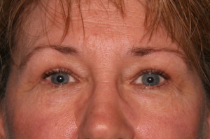 Eyelid Surgery