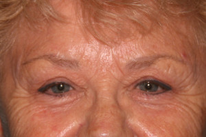 Eyelid Surgery