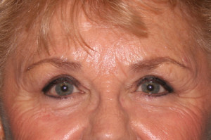 Eyelid Surgery