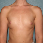 Breast Augmentation