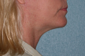 Neck Lift