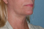 Neck Lift