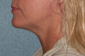 Neck Lift