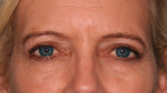 Eyelid Surgery