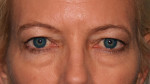 Eyelid Surgery