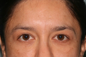 Eyelid Surgery