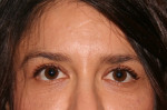 Eyelid Surgery