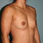 Breast Augmentation