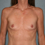 Breast Implant Removal