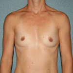 Breast Augmentation
