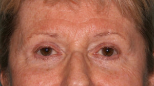 Eyelid Surgery