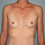 Breast Augmentation