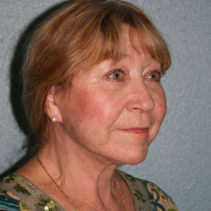 Face Lift