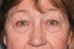 Eyelid Surgery