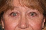 Eyelid Surgery