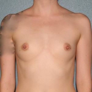 Breast Augmentation