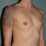 Breast Augmentation
