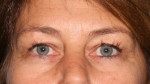Eyelid Surgery