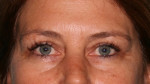 Eyelid Surgery