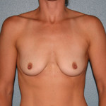 Breast Augmentation