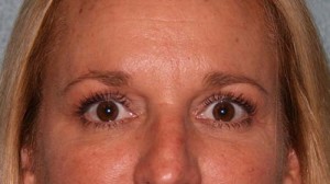 Eyelid Surgery