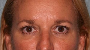 Eyelid Surgery