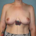 Breast Lift