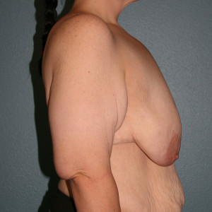 Breast Lift
