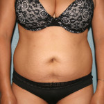 Tummy Tuck