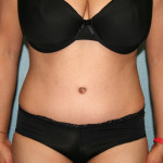 Tummy Tuck