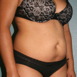 Tummy Tuck