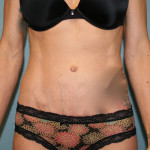 Tummy Tuck