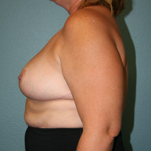 Breast Reduction