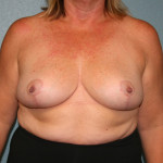Breast Reduction