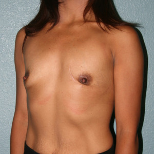 Breast Augmentation