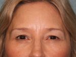 Eyelid Surgery