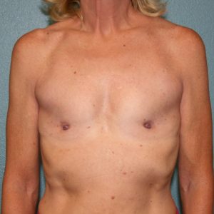 Breast Augmentation