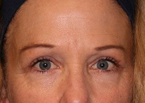 Eyelid Surgery