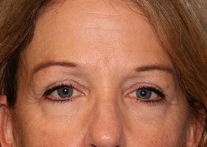 Eyelid Surgery