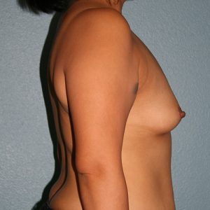 Breast Augmentation