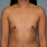 Breast Augmentation