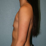 Breast Augmentation